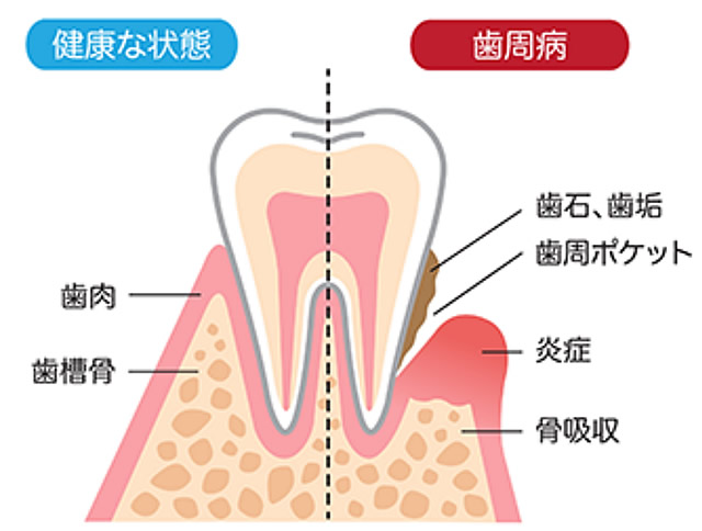 歯周病