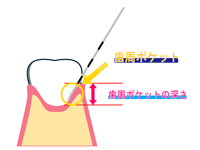 歯周ポケット検査