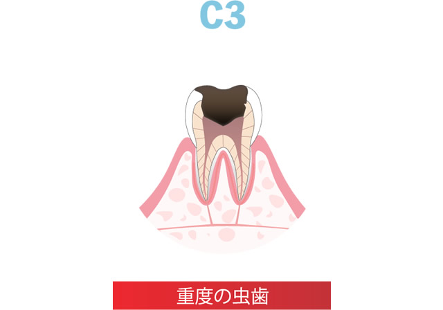 進行したむし歯