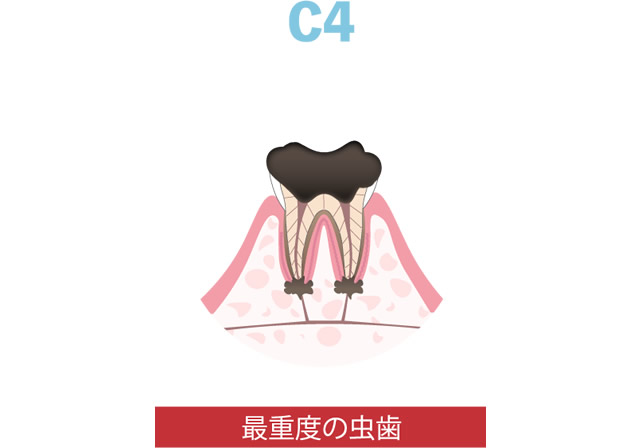 根の先の炎症